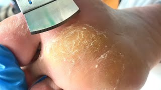 Callus removal from feetampFoot scraping dead skinasmr treatment【Xiao Yan pedicure】 [upl. by Bron]