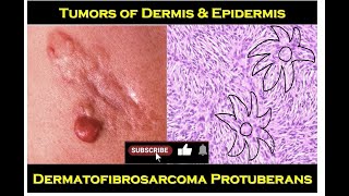 8n  Dermatofibrosarcoma Protuberans [upl. by Adon]