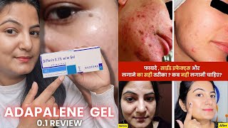 How to Use Adapalene Gel 01  Full Detail Video  Best Gel For Removing Blackheads and Pimples [upl. by Adnahsal]