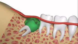 How To Safely and Quickly Have a Wisdom Tooth Extraction [upl. by Trebloc991]