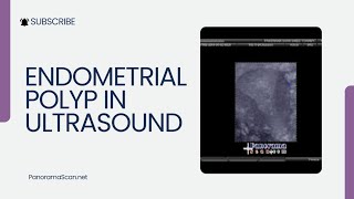 Endometrial Polyp in Ultrasound [upl. by Odrareve928]