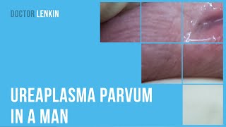 😟 Ureaplasma parvum in a man [upl. by Hairim881]