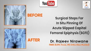 Watch the Procedure for In Situ Fixation in SCFE Treatment by Dr Rajeev Nirawane [upl. by Gyasi956]