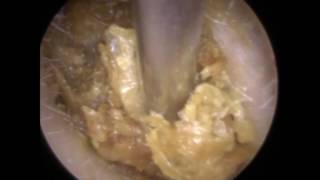 Golden Ear Wax Removal from Ear  Mr Neel Raithatha The Hear Clinic [upl. by Aisor265]