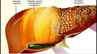 Hígado graso [upl. by Kinch]