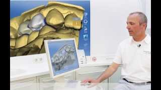 Tips amp Tricks  CEREC Dental Union [upl. by Pelagias]