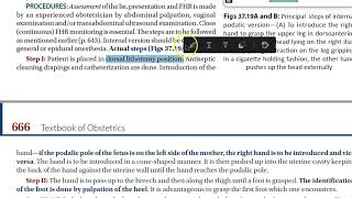 Obstetrics Internal version podalic second twin breech pregnancy delivery [upl. by Darrin]