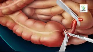 3D Animated Appendix Surgery Explained bySurgery Medi Care 3D [upl. by Annayehc]