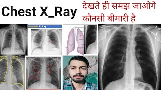 Chest XRay XRay Xray reading pneumonia Lungs Effusion  XRay Technician DoctorMBBS [upl. by Rodmann]