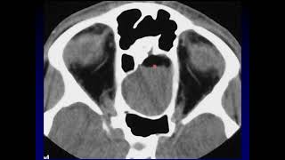 Imaging of the Paranasal Sinuses 4 [upl. by Mitchiner997]