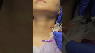 skinbooster  dermalfillers for Neck lines profhilo viscoderm antiagingtreatment skincaretips [upl. by Thrasher]