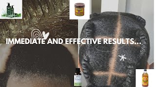 How I’m Treating My Dandruff Permanently At Home 23 Months Therapy Simple and Cheap [upl. by Enneillij]