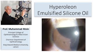 Emulsification of Silicone Oil in Eye [upl. by Nythsa]