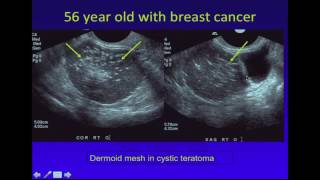 Ultrasound of Adnexal Masses [upl. by Novaat]