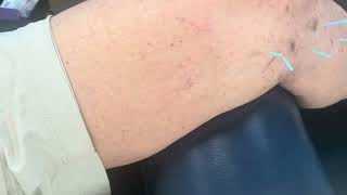 Dry needling against arthritis [upl. by Kerekes374]