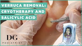 Verruca removal cryotherapy and salicylic acid [upl. by Annovad]