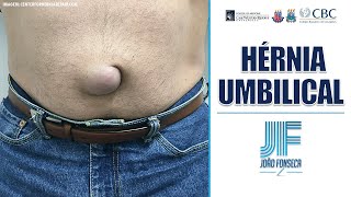 HÉRNIAS ABDOMINAIS Parte 5 UMBILICAL 👨🏽‍⚕️🚑 Joao Fonseca Cir Geral [upl. by Dennett]