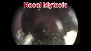 Nasal Myiasis peenash  mbbs shorts [upl. by Eldoree980]