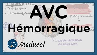 AVC Hémorragique et hémorragie cérébrale hémorragie cerveau [upl. by Aenehs]