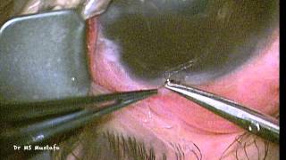 Glaucoma Drainage Device flushing and revision [upl. by Avek368]