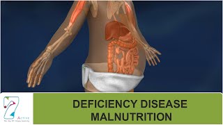 DEFICIENCY DISEASE  MALNUTRITION [upl. by Nytsirk544]