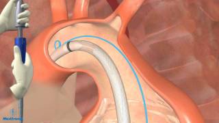 Thoracic Endovascular Aortic Aneurysm Repair in Dallas [upl. by Eliza]