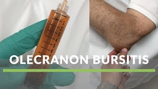 Olecranon Bursitis [upl. by Angelle]