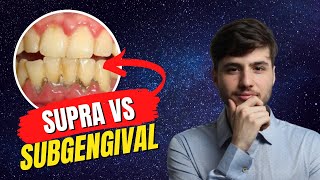 Entenda a diferença  Cálculo supragengival X subgengival  Periodontia [upl. by Ainoyek]