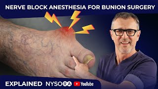 NERVE BLOCK ANESTHESIA FOR BUNION SURGERY [upl. by Narih803]