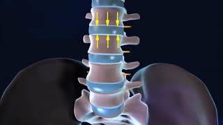 Tumor en la columna lumbar sintomas Tumor intradural [upl. by Siegfried228]