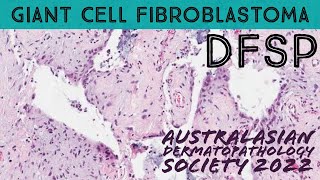 Giant cell fibroblastoma pediatric variant of dermatofibrosarcoma protuberans DFSP pathology [upl. by Olrak]