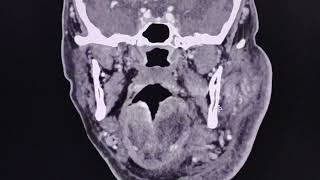 Acute sialadenitis of the parotid gland  CT findings [upl. by Arita]