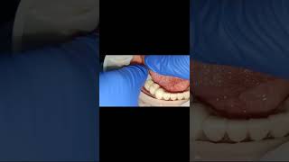 2 times failed lower molar implant site replaced with screw retaiend short implants bridge fixing [upl. by Griffie194]