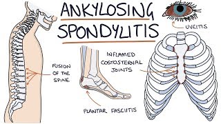 Ankylosing Spondylitis Visual Explanation for Students [upl. by Nyladam175]