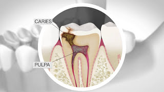 ¿Qué es una Endodoncia ¿Duele la endodoncia [upl. by Rochella206]