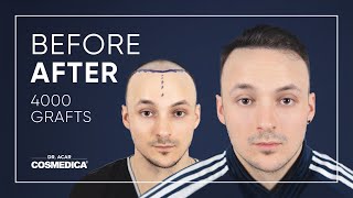 Excellent Before amp After Hair Transplant with Dr Acar [upl. by At98]