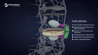 OLIF Surgery Procedure Video with Double Medical Oblique Lateral Intervertebral Fusion Cage System [upl. by Esihcoc200]