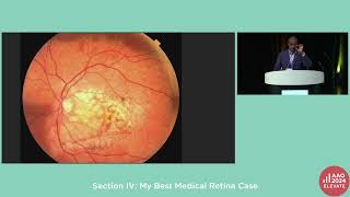 RET06Section IV My Best Medical Retina Case [upl. by Lled]