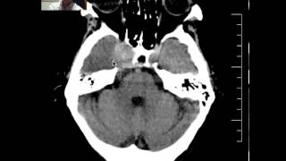 Head CT of Meningioma DISCUSSION by radiologist [upl. by Bashee282]