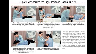 Epley Manoeuvre for Right Posterior Canal BPPV [upl. by Nicoline539]