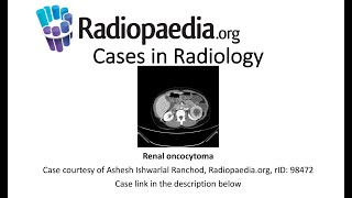 Renal oncocytoma Radiopaediaorg Cases in Radiology [upl. by Thilde]