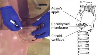 Emergency Needle Cricothyrotomy Procedure Explained [upl. by Aineg900]