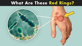 Ringworm Disease Tinea  Symptoms Causes And Treatment UrduHndi [upl. by Ecnerret621]