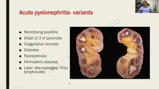 Pyelonephritis  Renal Pathology  RATS in Pathology [upl. by Attesoj]