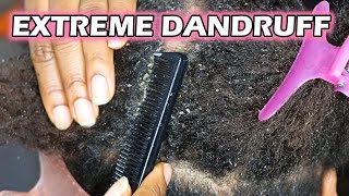 How to remove Dandruff From Natural Hair  DiscoveringNatural [upl. by Noslen84]