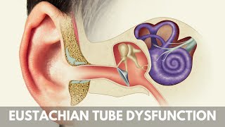 What is Eustachian Tube Dysfunction [upl. by Vyky]