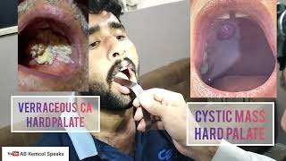 Examination of Oral Cavity  Mouth Examination  ENT Examination Part 03 [upl. by Arbmik]