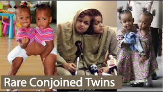 Top 5 Rare Conjoined Twins। Conjoined Twins Separated Successfully । Born Different [upl. by Launcelot258]