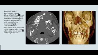 Neurofibromatosis neckㅣfibrous dysplasiaㅣCHARGE syndrome [upl. by Ecyor413]