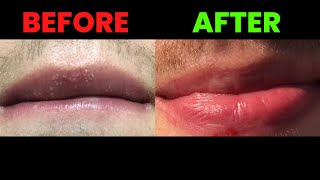 Fordyce spots on lips removal  NEW UPDATE IT WORKS 🙏🙏🙏 [upl. by Parnell]